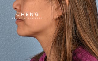 Hidden Patients Before & After Gallery - Patient 263878 - Image 9