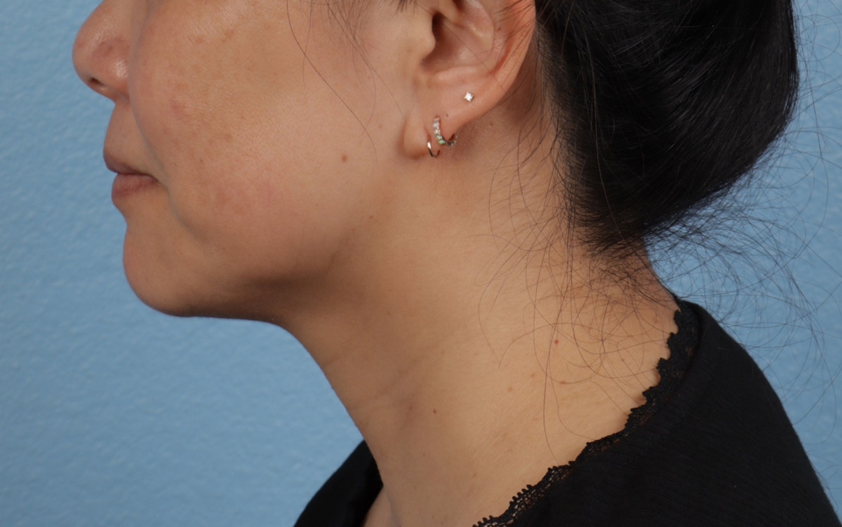 Pigment Laser Before & After Gallery - Patient 360523 - Image 10