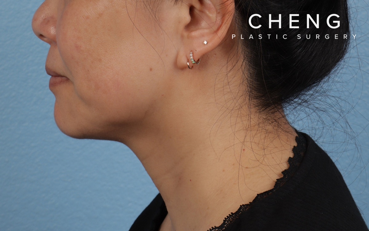 Hidden Patients Before & After Gallery - Patient 263878 - Image 10