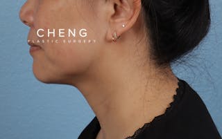 Hidden Patients Before & After Gallery - Patient 263878 - Image 10