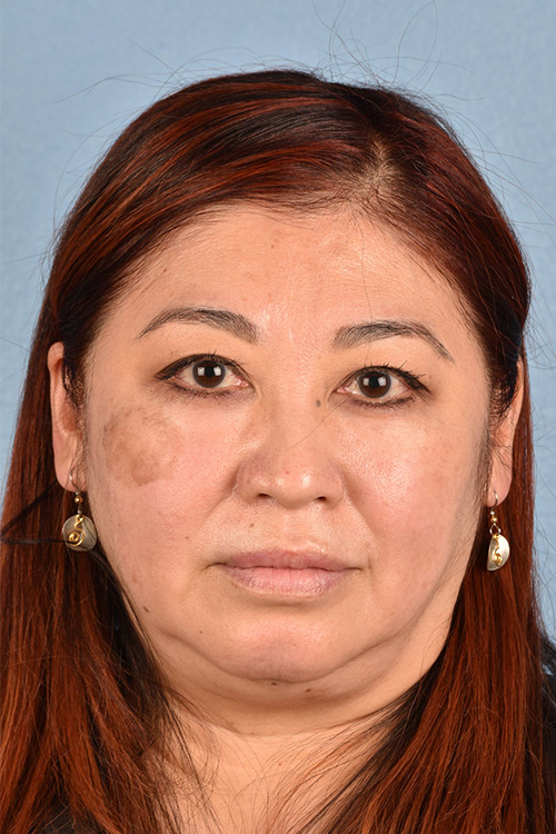 Pigment Laser Before & After Gallery - Patient 332305 - Image 1