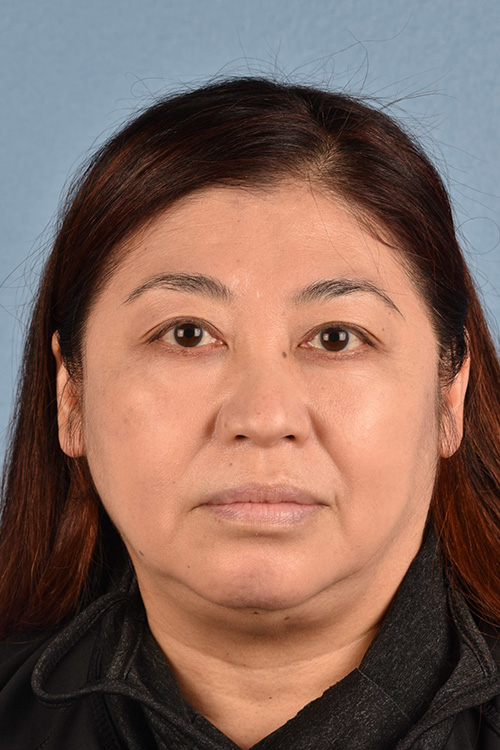 Pigment Laser Before & After Gallery - Patient 332305 - Image 2