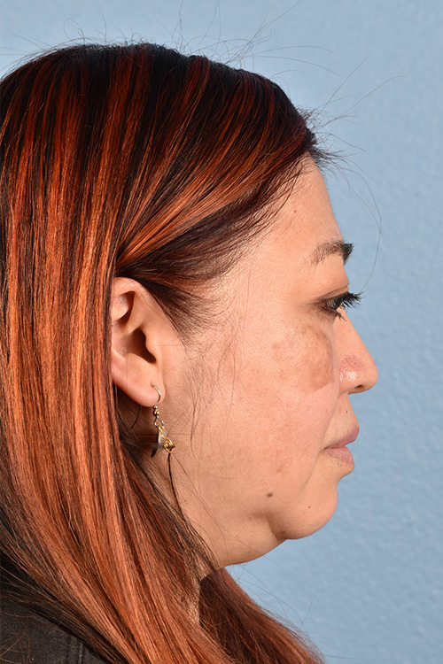Pigment Laser Before & After Gallery - Patient 332305 - Image 3