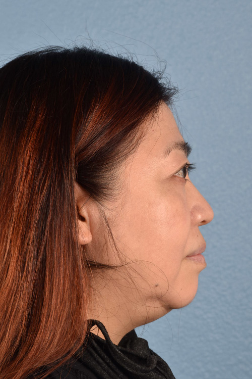 Pigment Laser Before & After Gallery - Patient 332305 - Image 4