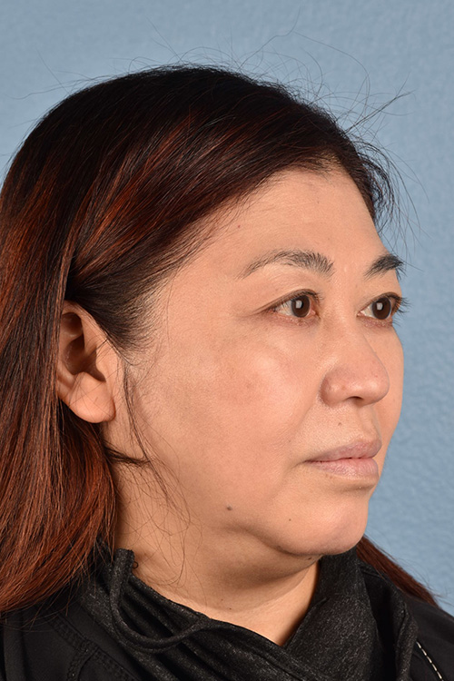 Pigment Laser Before & After Gallery - Patient 332305 - Image 6