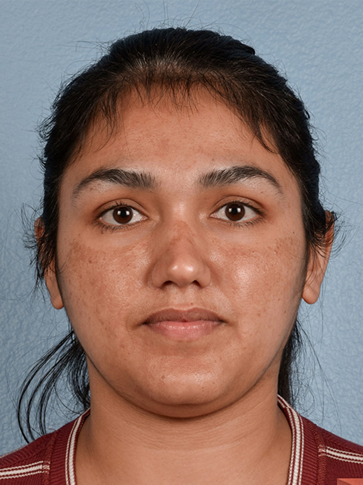 Pigment Laser Before & After Gallery - Patient 117619 - Image 1