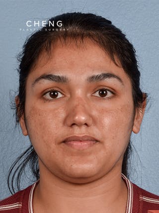 Hidden Patients Before & After Gallery - Patient 178995 - Image 1