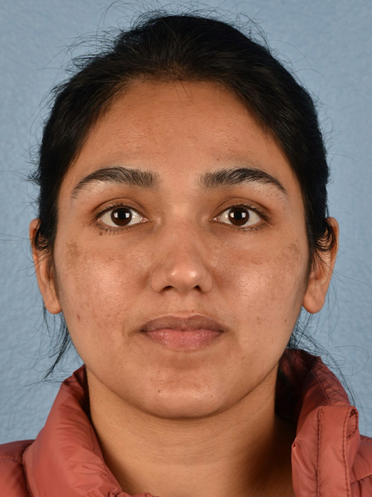 Pigment Laser Before & After Gallery - Patient 117619 - Image 2