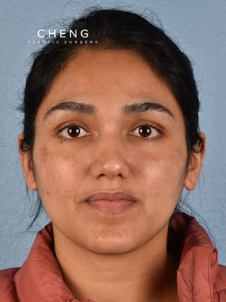 Hidden Patients Before & After Gallery - Patient 178995 - Image 2