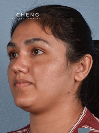 Hidden Patients Before & After Gallery - Patient 178995 - Image 3