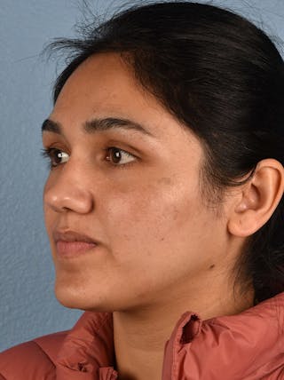 Hidden Patients Before & After Gallery - Patient 178995 - Image 4