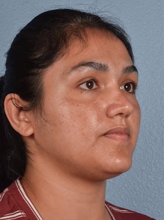 Hidden Patients Before & After Gallery - Patient 178995 - Image 5