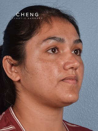 Hidden Patients Before & After Gallery - Patient 178995 - Image 5