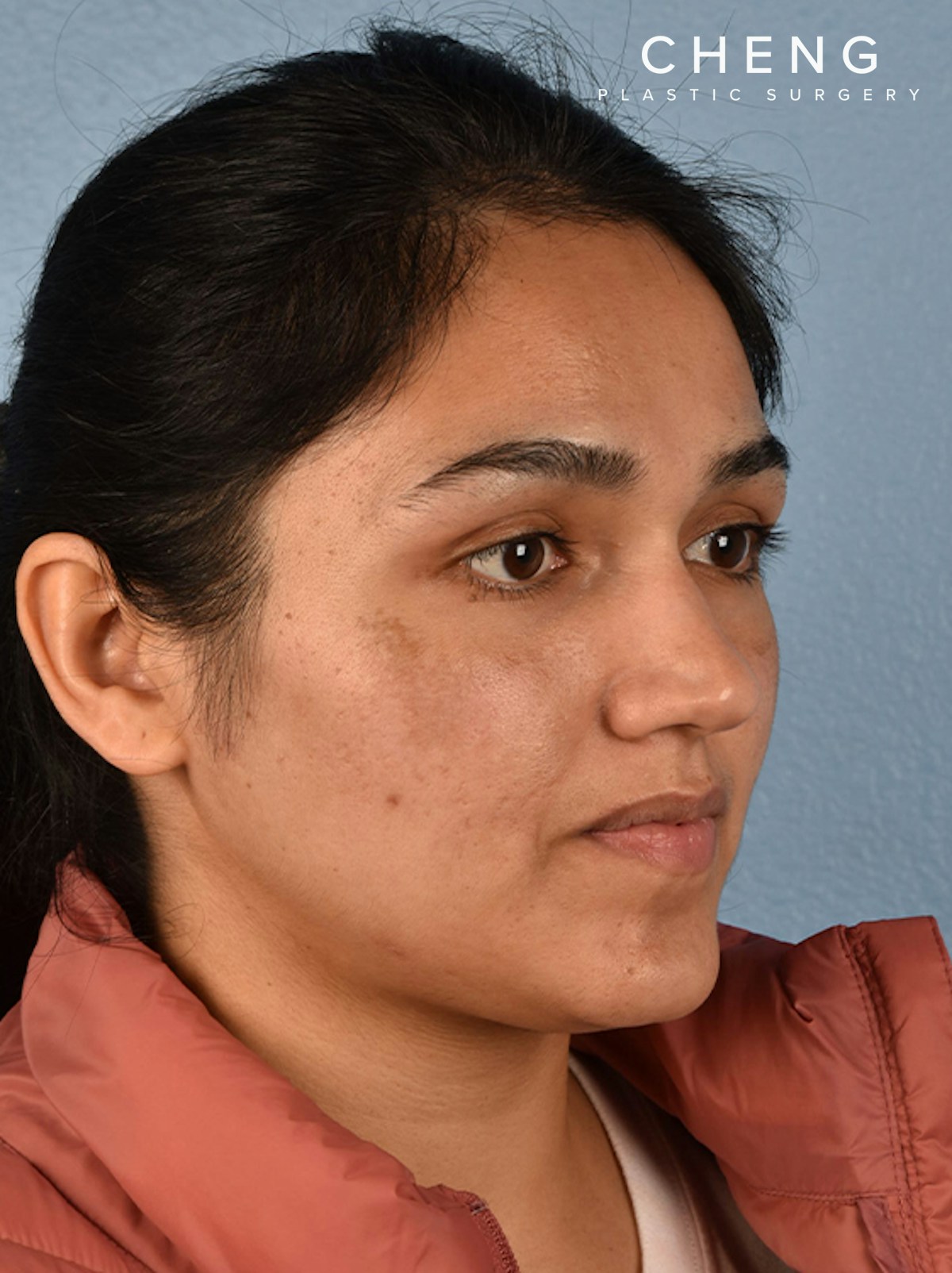 Hidden Patients Before & After Gallery - Patient 178995 - Image 6