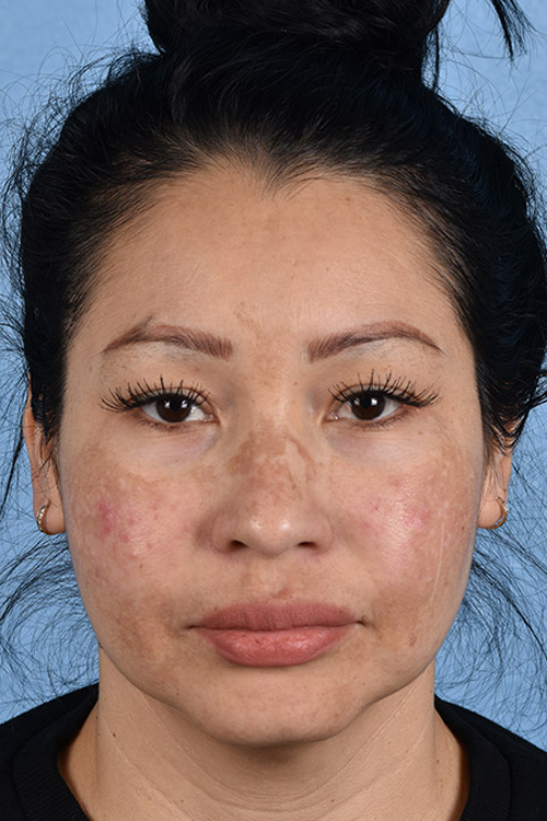 Pigment Laser Before & After Gallery - Patient 555927 - Image 1