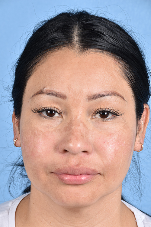 Pigment Laser Before & After Gallery - Patient 555927 - Image 2
