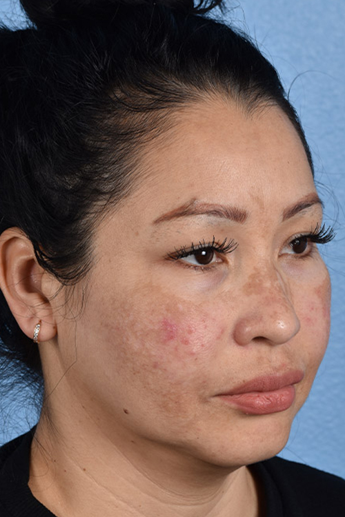 Pigment Laser Before & After Gallery - Patient 555927 - Image 3