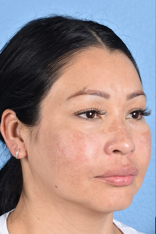 Pigment Laser Before & After Gallery - Patient 555927 - Image 4