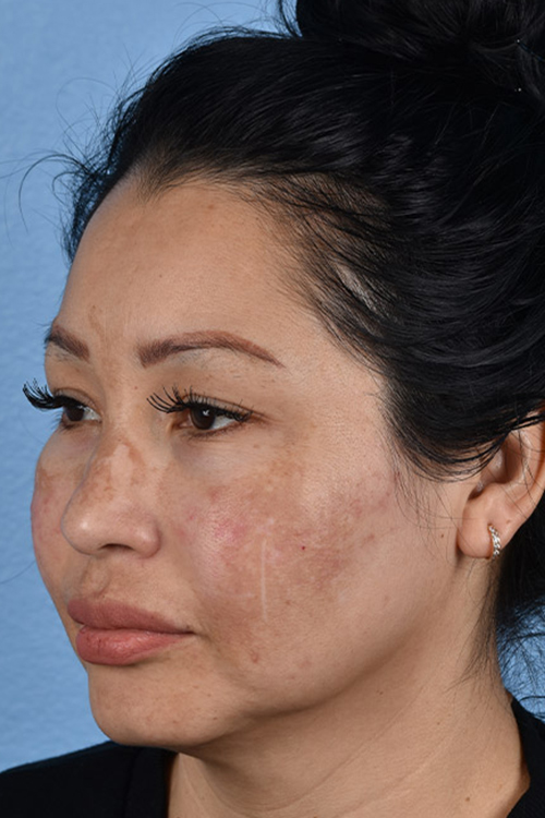 Pigment Laser Before & After Gallery - Patient 555927 - Image 5