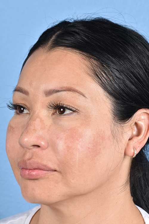 Pigment Laser Before & After Gallery - Patient 555927 - Image 6