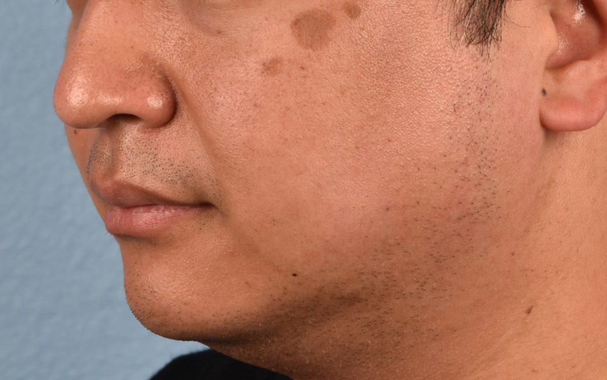 Pigment Laser Before & After Gallery - Patient 266397 - Image 1