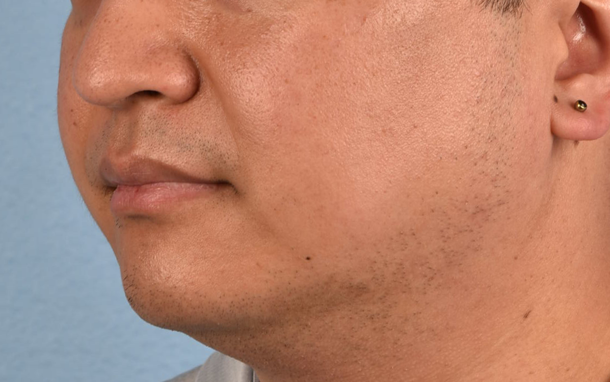 Pigment Laser Before & After Gallery - Patient 266397 - Image 2