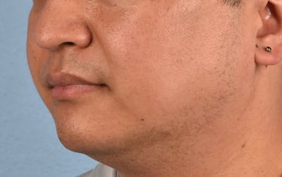 Pigment Laser Before & After Gallery - Patient 266397 - Image 2