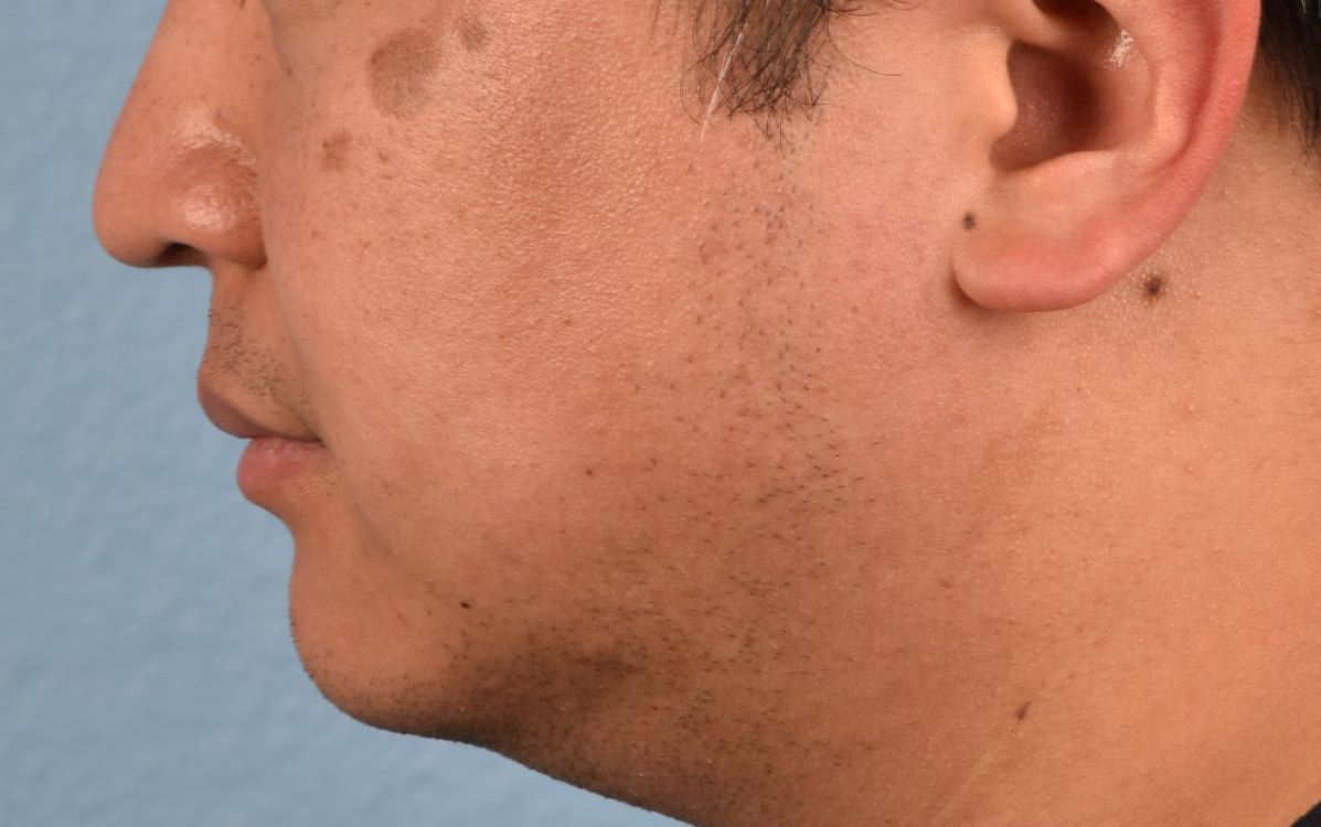 Pigment Laser Before & After Gallery - Patient 266397 - Image 3