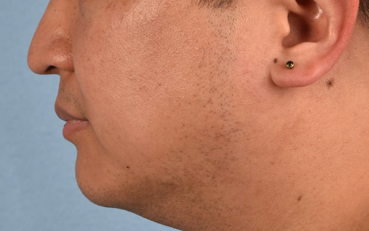 Pigment Laser Before & After Gallery - Patient 266397 - Image 4