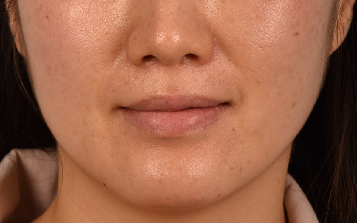 Pigment Laser Before & After Gallery - Patient 230352 - Image 1