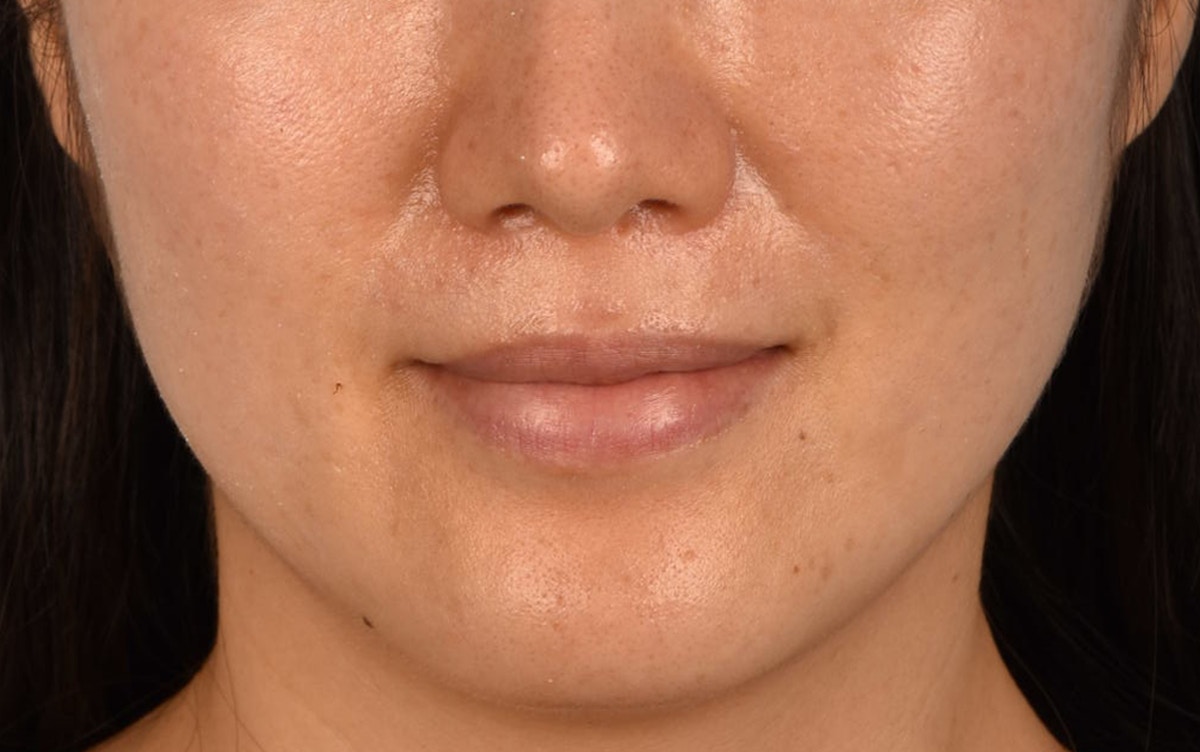 Pigment Laser Before & After Gallery - Patient 230352 - Image 2