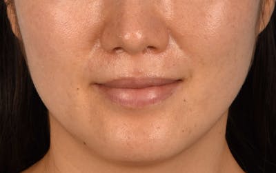 Pigment Laser Before & After Gallery - Patient 230352 - Image 2
