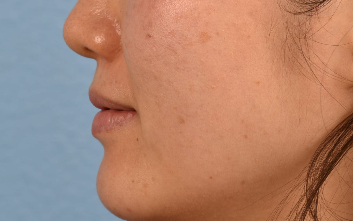 Pigment Laser Before & After Gallery - Patient 230352 - Image 3