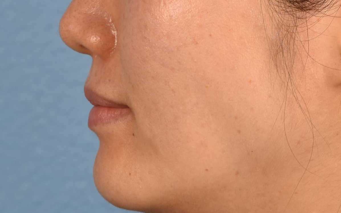 Pigment Laser Before & After Gallery - Patient 230352 - Image 4