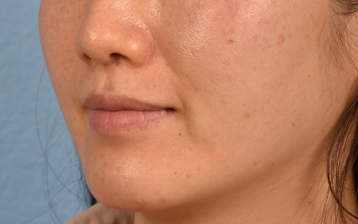 Pigment Laser Before & After Gallery - Patient 230352 - Image 5