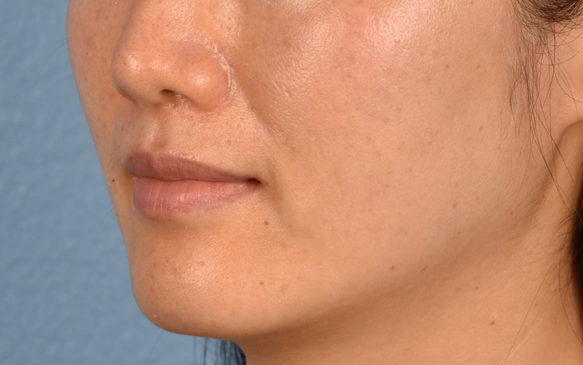 Pigment Laser Before & After Gallery - Patient 230352 - Image 6