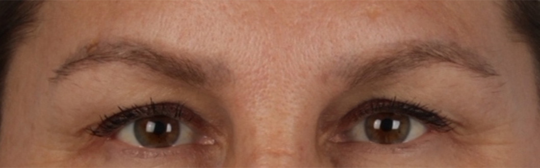 Hidden Patients Before & After Gallery - Patient 283134 - Image 1