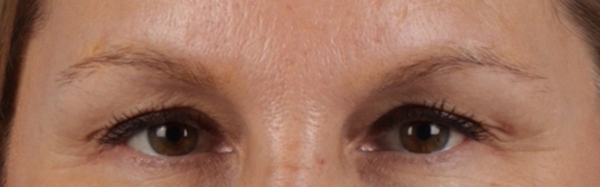 Laser Tattoo Removal Before & After Gallery - Patient 390037 - Image 2