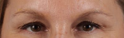 Laser Tattoo Removal Before & After Gallery - Patient 390037 - Image 2