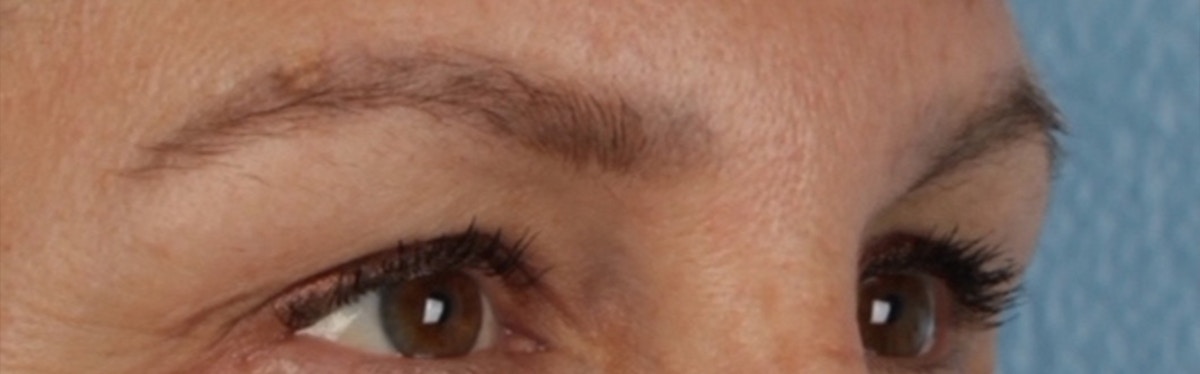 Laser Tattoo Removal Before & After Gallery - Patient 390037 - Image 3
