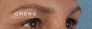Hidden Patients Before & After Gallery - Patient 283134 - Image 3