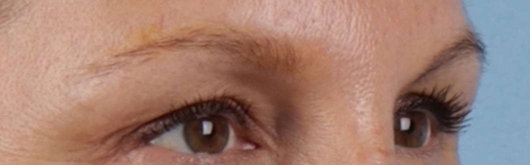 Hidden Patients Before & After Gallery - Patient 283134 - Image 4