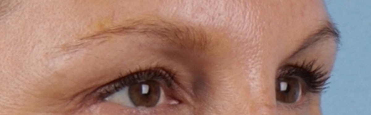 Laser Tattoo Removal Before & After Gallery - Patient 390037 - Image 4