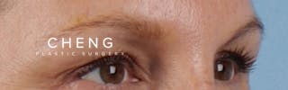 Hidden Patients Before & After Gallery - Patient 283134 - Image 4