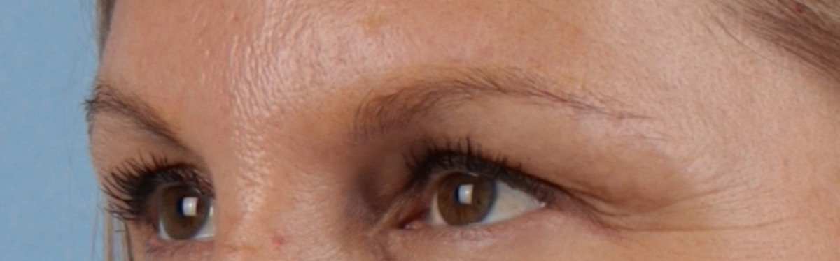 Laser Tattoo Removal Before & After Gallery - Patient 390037 - Image 6