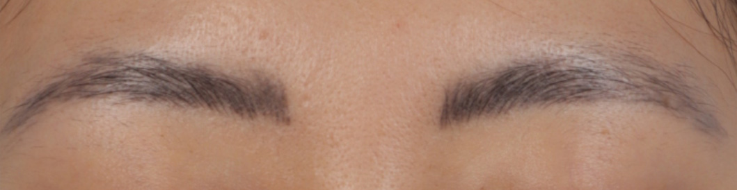 Laser Tattoo Removal Before & After Gallery - Patient 288404 - Image 1