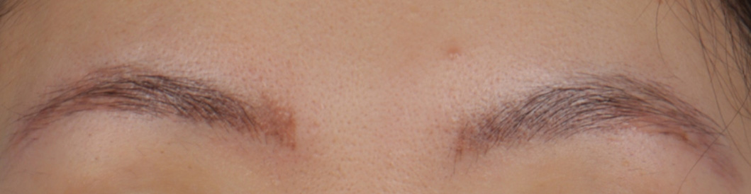 Laser Tattoo Removal Before & After Gallery - Patient 288404 - Image 2