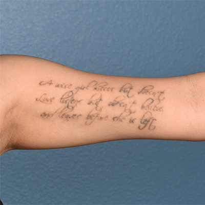 Laser Tattoo Removal Before & After Gallery - Patient 107640 - Image 1
