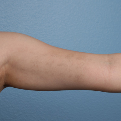 Laser Tattoo Removal Before & After Gallery - Patient 107640 - Image 2