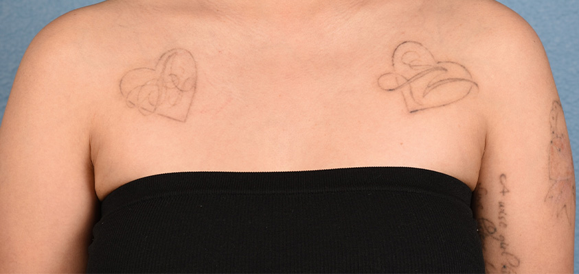 Laser Tattoo Removal Before & After Gallery - Patient 229615 - Image 1